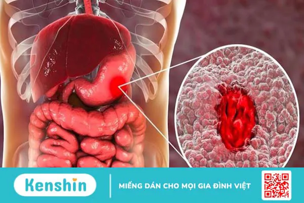 6 nhóm thuốc dạ dày hiệu quả nhất hiện nay và lưu ý khi sử dụng thuốc