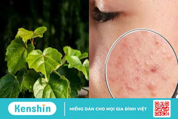 6 tác dụng của lá thường xuân đối với sức khỏe bạn cần biết