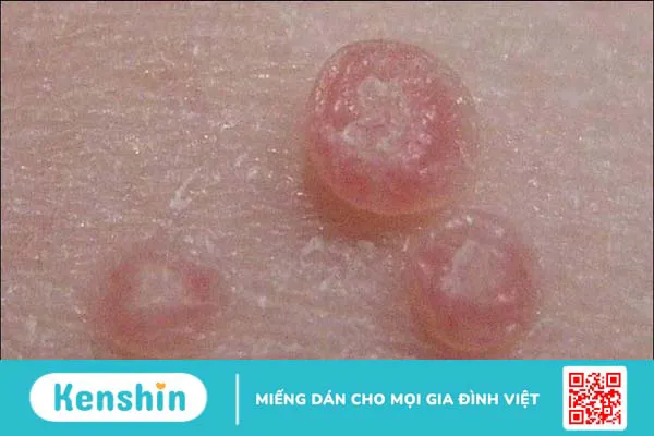 6 triệu chứng u mềm lây cần lưu ý để phát hiện bệnh sớm