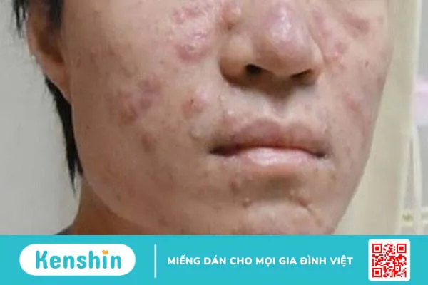 6 triệu chứng u mềm lây cần lưu ý để phát hiện bệnh sớm