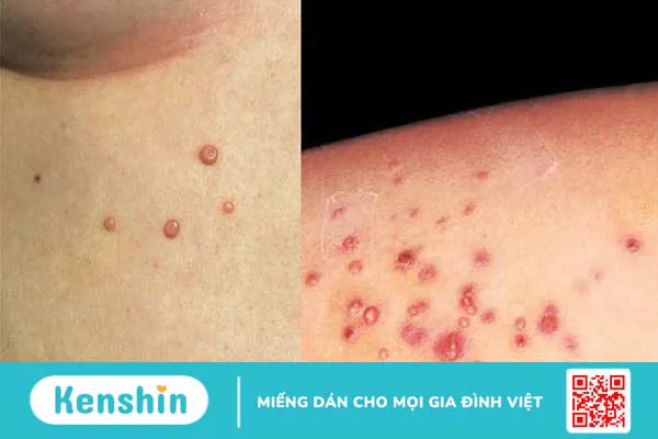 6 triệu chứng u mềm lây cần lưu ý để phát hiện bệnh sớm