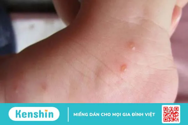 6 triệu chứng u mềm lây cần lưu ý để phát hiện bệnh sớm