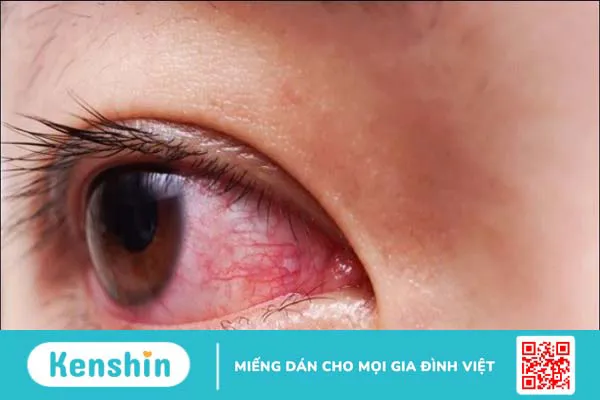 6 triệu chứng u mềm lây cần lưu ý để phát hiện bệnh sớm