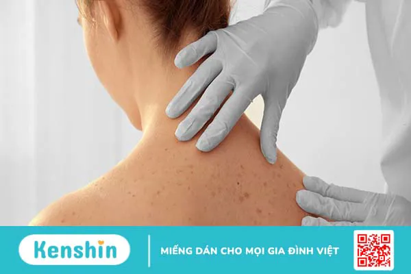 6 triệu chứng u mềm lây cần lưu ý để phát hiện bệnh sớm