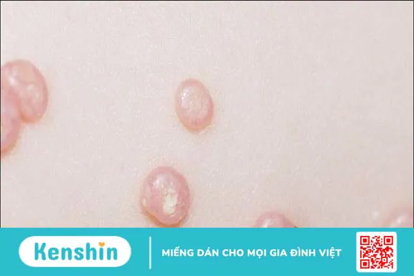 6 triệu chứng u mềm lây cần lưu ý để phát hiện bệnh sớm