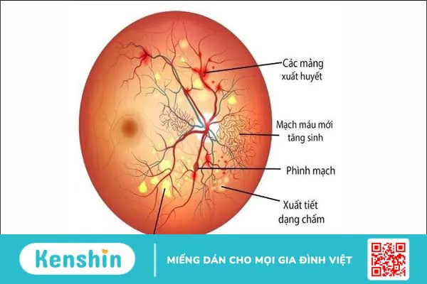 7 biến chứng của bệnh tiểu đường lên mắt và các biện pháp phòng ngừa