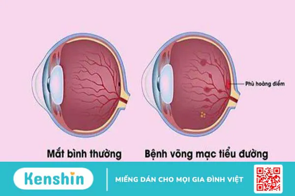 7 biến chứng của bệnh tiểu đường lên mắt và các biện pháp phòng ngừa