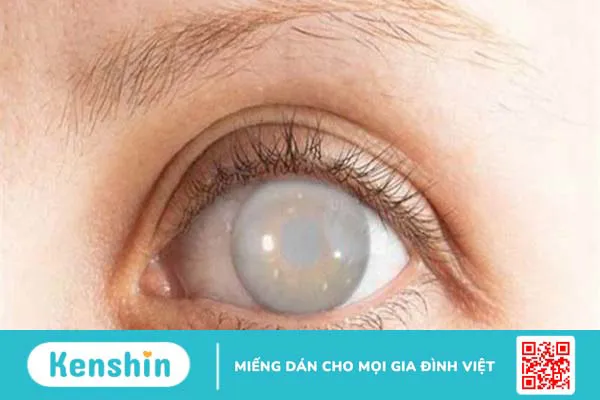 7 biến chứng của bệnh tiểu đường lên mắt và các biện pháp phòng ngừa