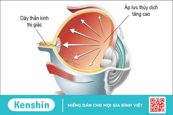 7 biến chứng của bệnh tiểu đường lên mắt và các biện pháp phòng ngừa