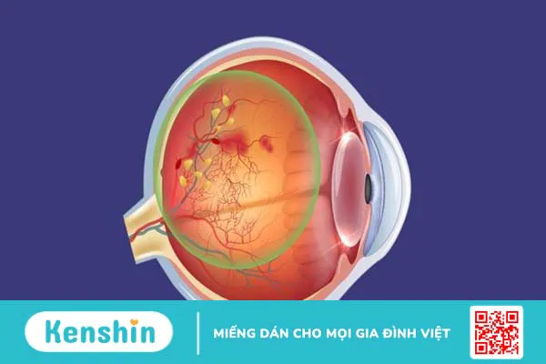 7 biến chứng của bệnh tiểu đường lên mắt và các biện pháp phòng ngừa