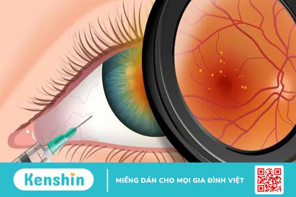 7 biến chứng của bệnh tiểu đường lên mắt và các biện pháp phòng ngừa