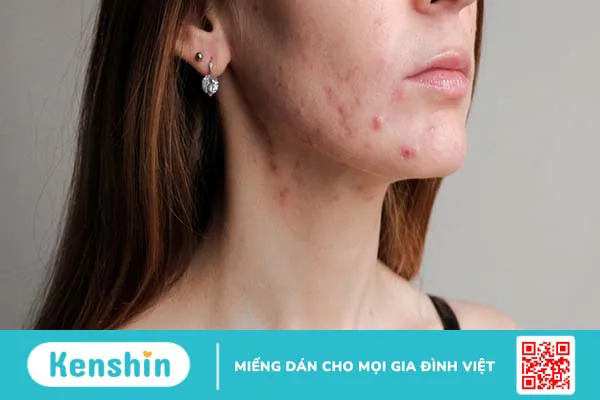 7 biến chứng viêm ruột bạn không nên bỏ qua