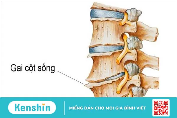 7 cách chữa gai cột sống có thể bạn chưa biết