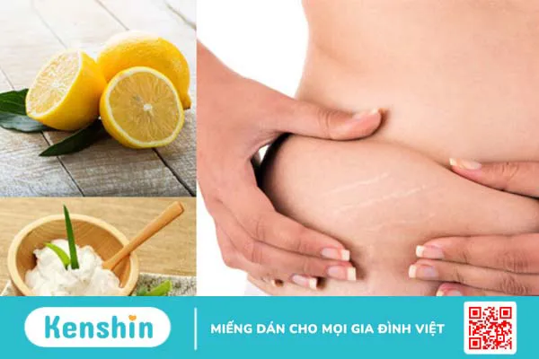 7 cách trị rạn da tại nhà hiệu quả không ngờ