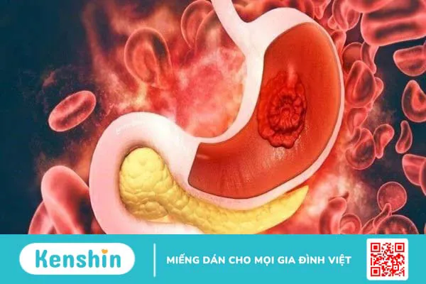 7 dấu hiệu ung thư dạ dày thường gặp nhất không nên chủ quan