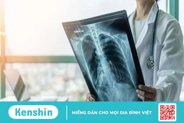 7 nguyên nhân lao phổi bạn cần lưu lý để tránh bệnh