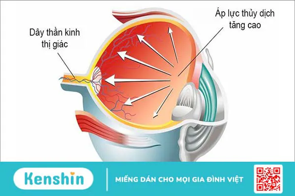 7 nguyên nhân tăng nhãn áp bạn không nên bỏ qua