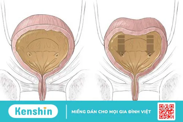 7 nguyên nhân tiểu đêm có thể bạn chưa biết