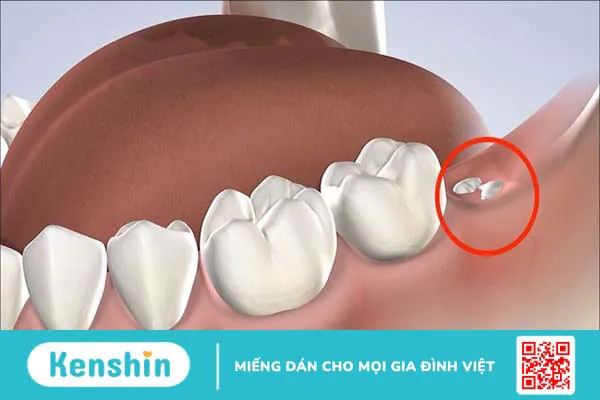 7 triệu chứng mọc răng khôn bạn cần lưu ý