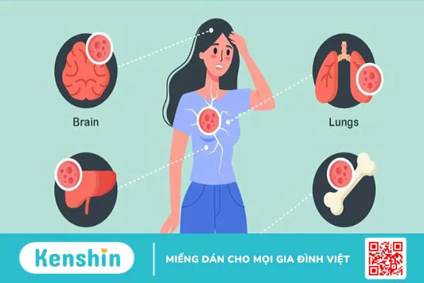 7 yếu tố nguy cơ ung thư vú và dấu hiệu cảnh báo