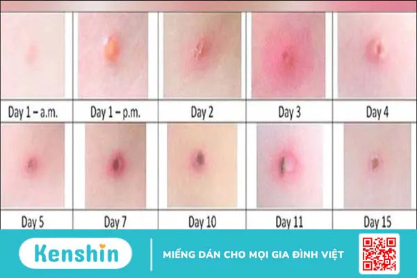 8 biến chứng bệnh thủy đậu gây nguy hiểm, bố mẹ không nên chủ quan