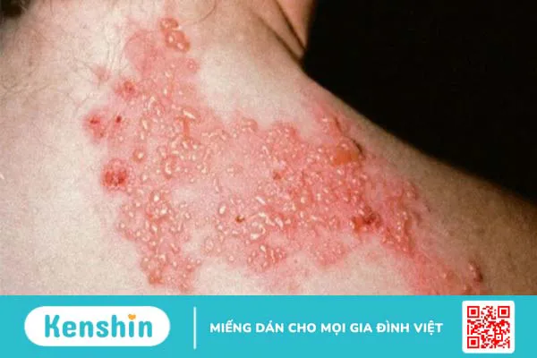 8 biến chứng bệnh thủy đậu gây nguy hiểm, bố mẹ không nên chủ quan