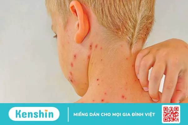 8 biến chứng suy gan nguy hiểm bạn không nên coi thường