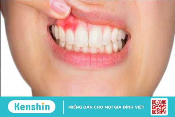 8 dấu hiệu nhận biết sớm ung thư nướu răng và cách điều trị