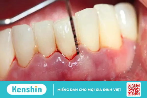 8 dấu hiệu nhận biết sớm ung thư nướu răng và cách điều trị