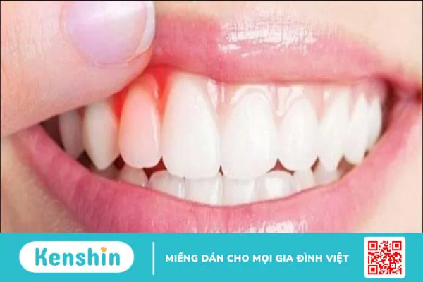 8 dấu hiệu nhận biết sớm ung thư nướu răng và cách điều trị