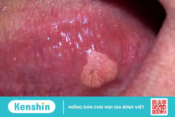 8 dấu hiệu nhận biết sớm ung thư nướu răng và cách điều trị