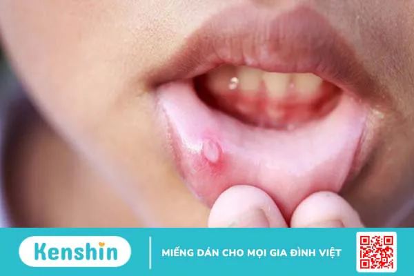 8 dấu hiệu nhận biết sớm ung thư nướu răng và cách điều trị