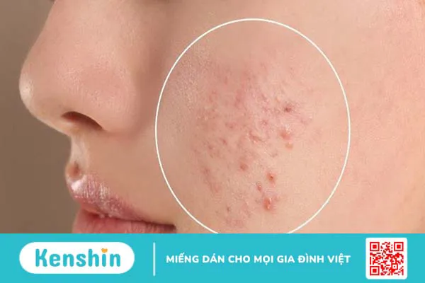 8 lợi ích của trà xanh đối với sức khỏe làn da bạn nên biết