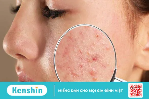 8 tác dụng của Actiso trong điều trị mụn trứng cá bạn không nên bỏ qua