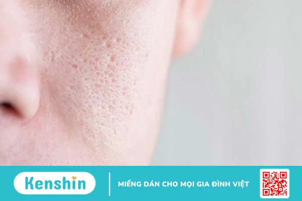 8 tác dụng của Actiso trong điều trị mụn trứng cá bạn không nên bỏ qua