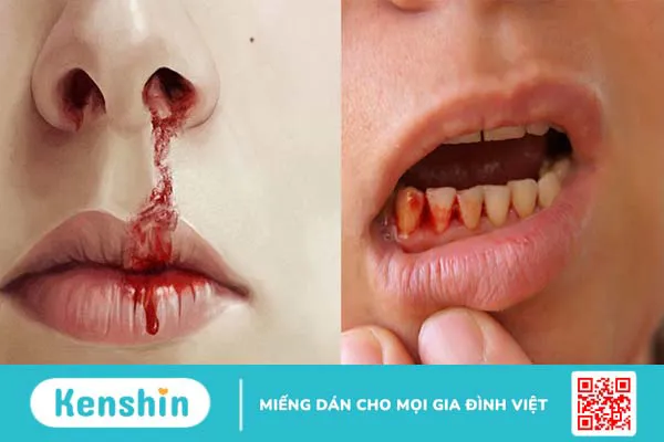 8 triệu chứng bệnh bạch cầu giúp bạn kịp thời phát hiện ra bệnh