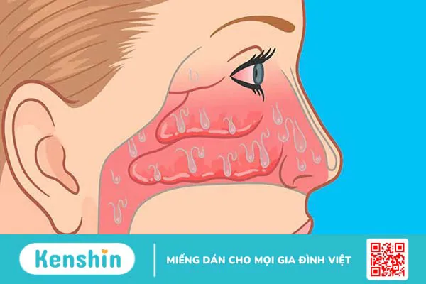 8 triệu chứng viêm mũi dị ứng phổ biến bạn cần biết