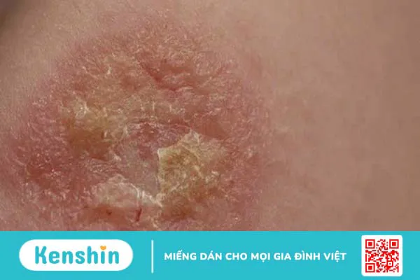 8 triệu chứng viêm mũi dị ứng phổ biến bạn cần biết