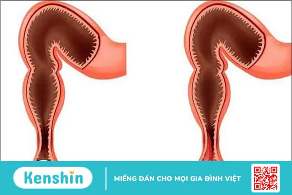 9 biến chứng bệnh lỵ cần lưu ý để tránh khỏi