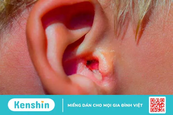 9 cách chữa viêm tai ngoài đơn giản tại nhà an toàn và hiệu quả