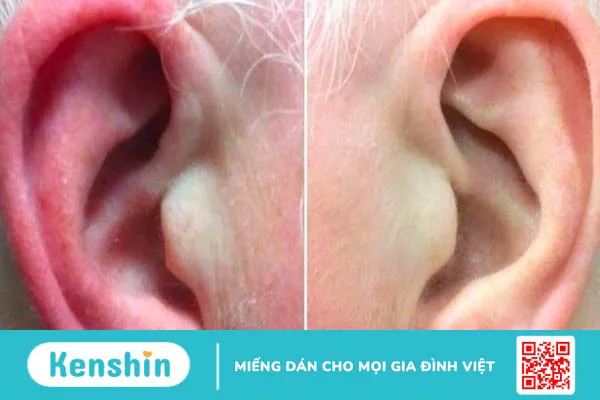 9 cách chữa viêm tai ngoài đơn giản tại nhà an toàn và hiệu quả