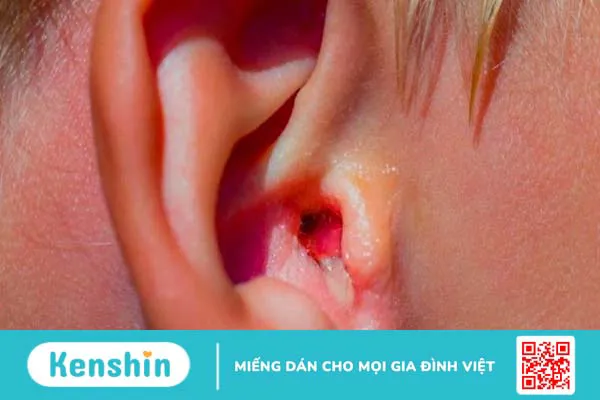 9 cách chữa viêm tai ngoài đơn giản tại nhà an toàn và hiệu quả