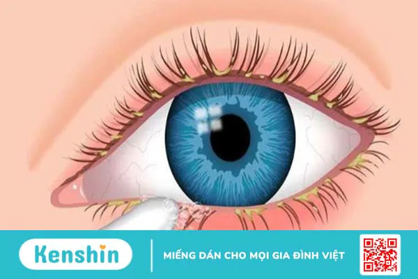 9 cách trị khô mắt tại nhà hiệu quả bạn nên biết!