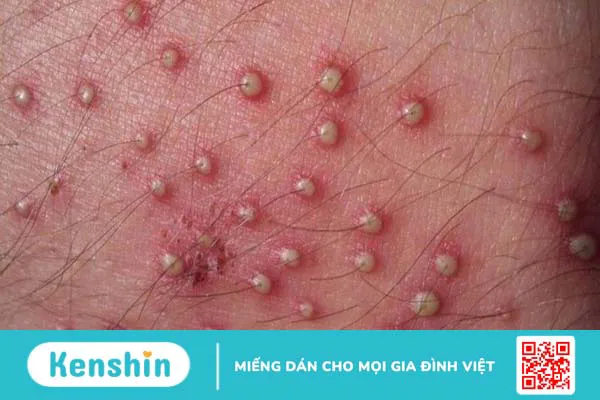 9 cách trị mụn nhọt hiệu quả tại nhà từ mẹo đơn giản