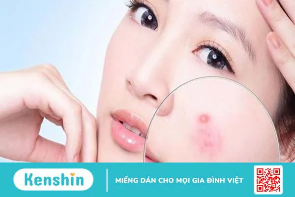 9 cách trị mụn nhọt hiệu quả tại nhà từ mẹo đơn giản