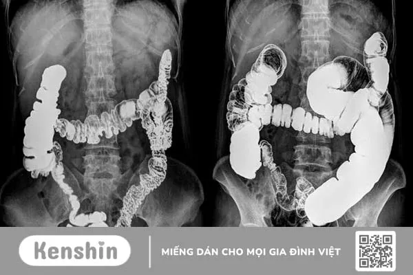 9 dấu hiệu ung thư đại tràng giai đoạn 1 bạn không nên chủ quan