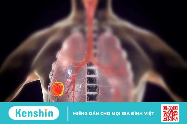 9 dấu hiệu ung thư phổi giai đoạn đầu tuyệt đối đừng bỏ qua!