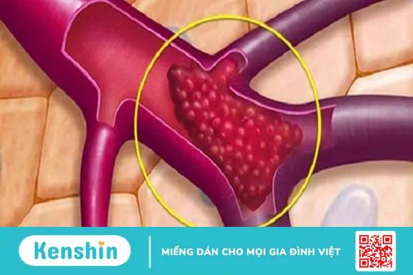 9 di chứng thần kinh hậu Covid và cách điều trị tại nhà hiệu quả