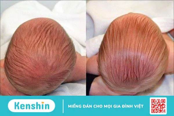 9 mẹo dân gian hỗ trợ chữa méo đầu ở trẻ sơ sinh hiệu quả