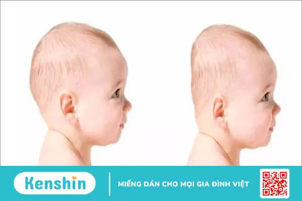 9 mẹo dân gian hỗ trợ chữa méo đầu ở trẻ sơ sinh hiệu quả